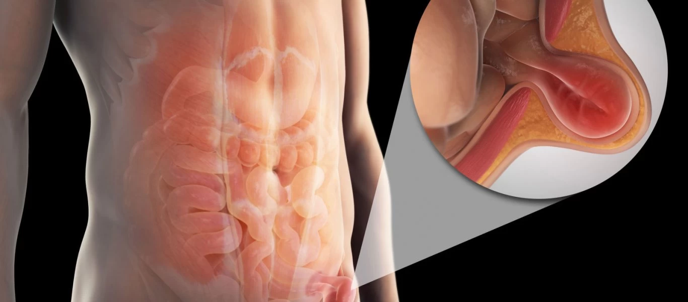 Δείτε τι προκαλεί την βουβωνική κήλη - Ποια τα συμπτώματά της